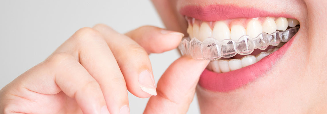 Obtenir une solution d’orthodontie invisible