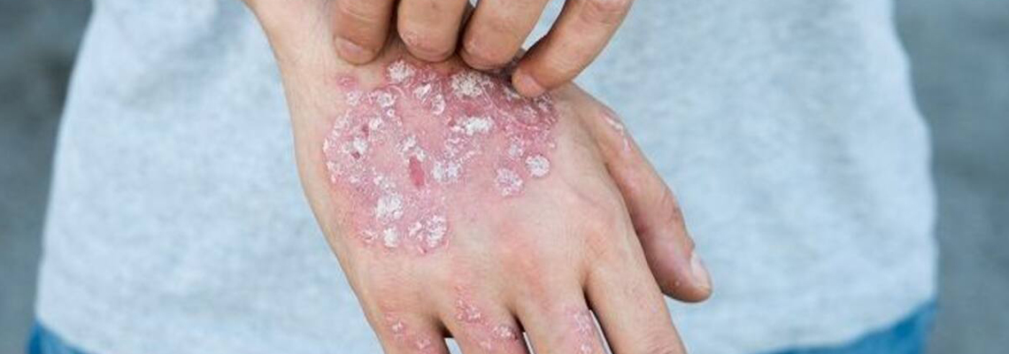 psoriasis